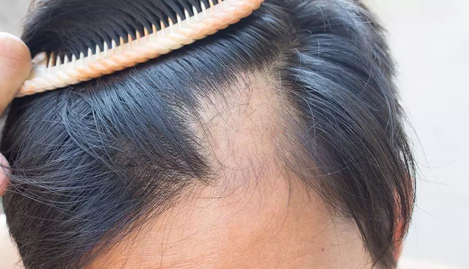 Hair loss help and solutions in Slidell and New Orleans Hair loss help and solutions in Slidell and New Orleans